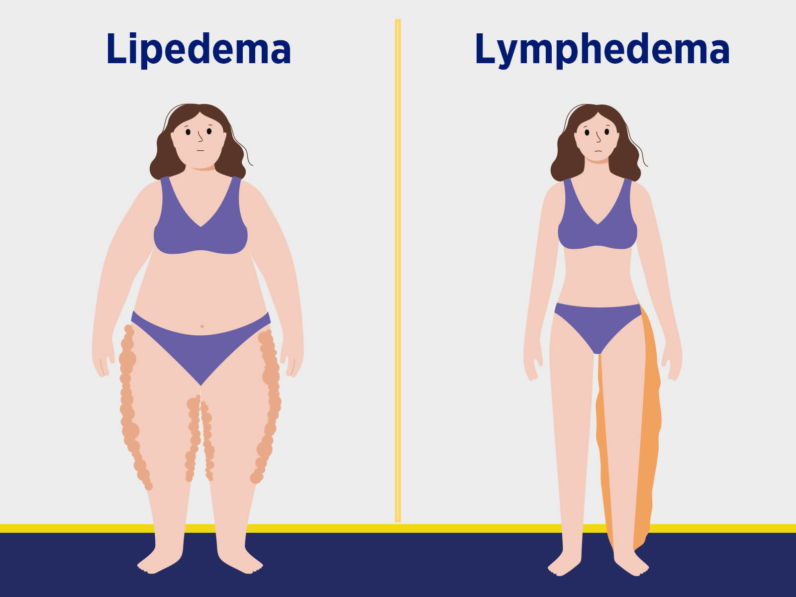 Lipedema