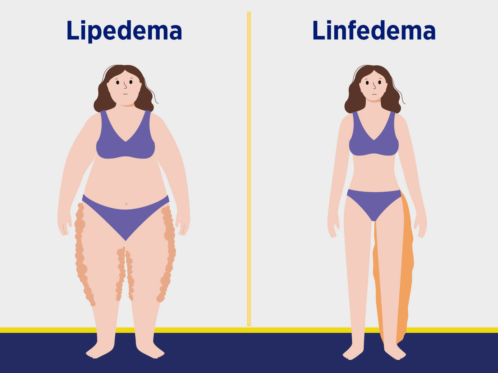 Lipedema