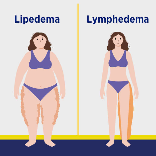 Lipedema