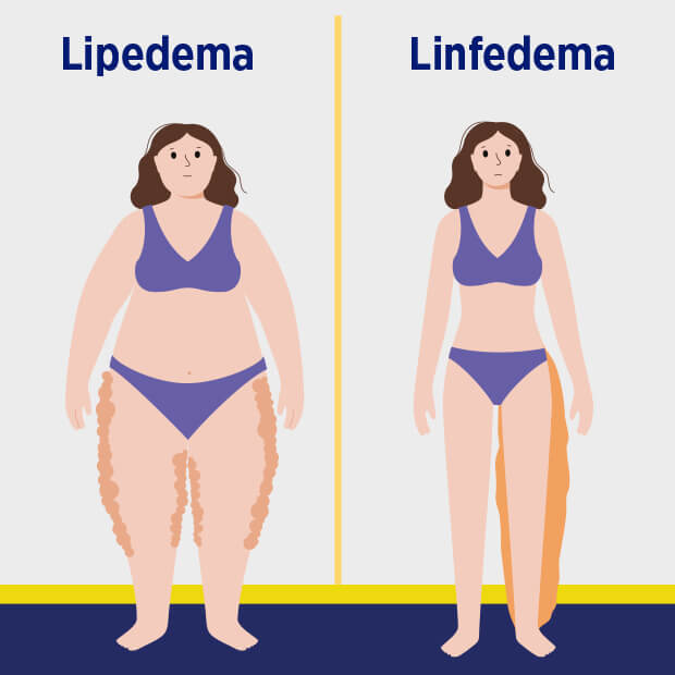 Lipedema